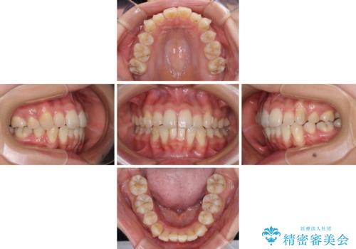 【モニター】 インビザラインによる後戻りの再矯正治療の治療中
