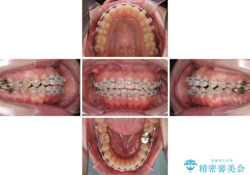 前歯のデコボコを治したい ワイヤー矯正の治療中