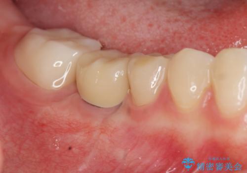 臼歯インプラント補綴の治療後