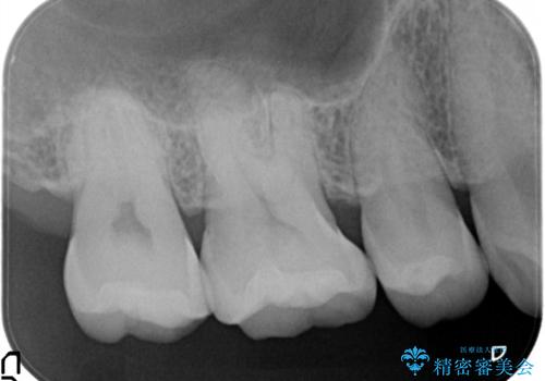 メタルフリーの治療 メタルインレーからセラミックインレーへの治療後