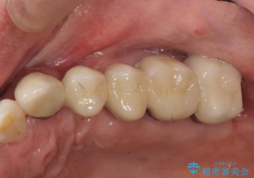 歯周病 側方力に対抗するブリッジ補綴の治療後