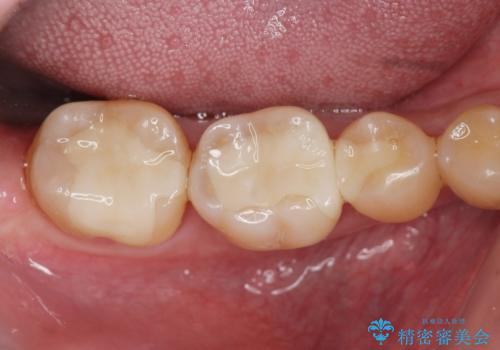歯の神経を残す、丁寧な虫歯の除去の症例 治療後
