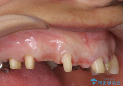 過度な咬合力 歯ぎしりで抜けた歯の欠損補綴の治療中