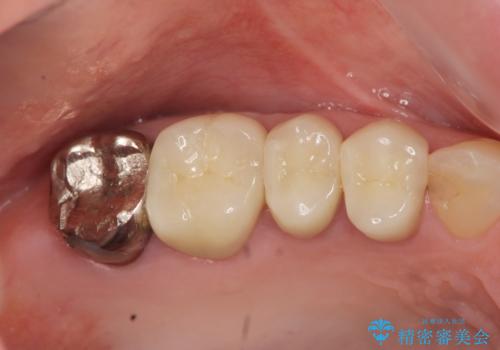 精度の高いセラミッククラウンの症例 治療後