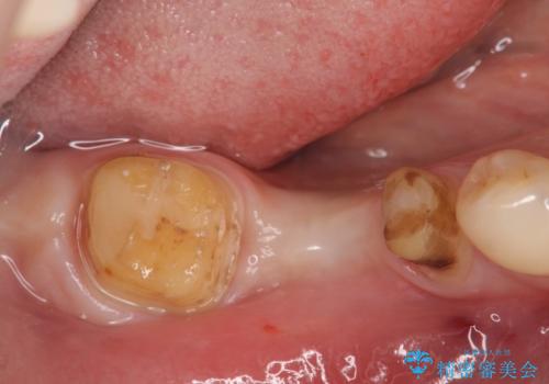 臼歯インプラント補綴の治療中