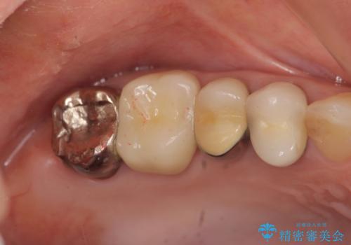 精度の高いセラミッククラウンの症例 治療前