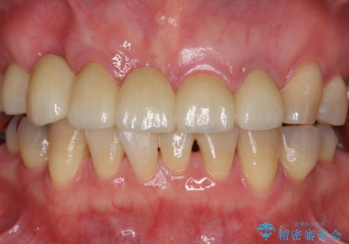 過度な咬合力 歯ぎしりで抜けた歯の欠損補綴の治療後