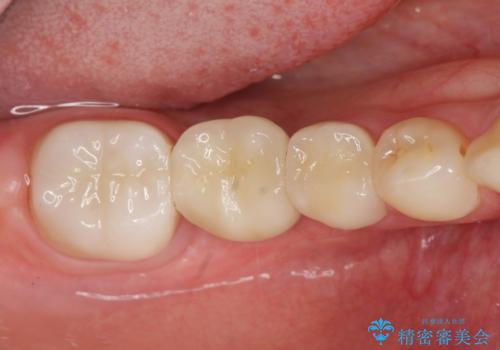 臼歯インプラント補綴の治療後