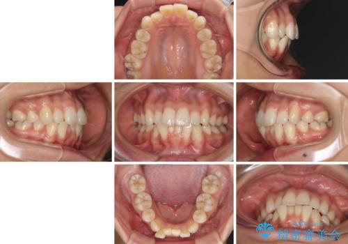 【モニター】 インビザラインによる後戻りの再矯正治療の治療前