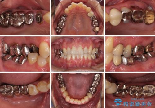折れてしまった奥歯 インプラントによる補綴治療の治療前