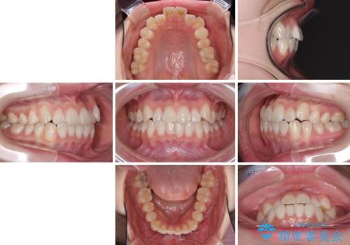 海外留学をしながら歯並びを整えたい インビザラインによる矯正治療の治療前