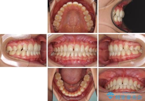 抜歯矯正の後戻りによるすきっ歯をインビザラインでの治療前
