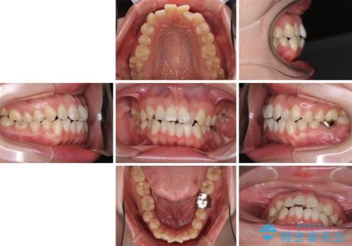 前歯のデコボコを治したい ワイヤー矯正の治療前
