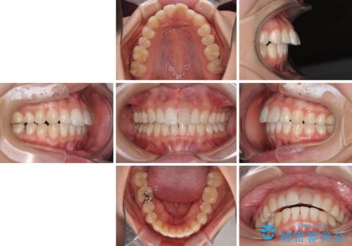 気になる前歯を治したい インビザライン矯正とオールセラミッククラウンの治療前