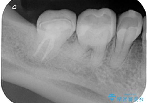 定期検診にて膿の出口を見つけた。精密根管治療の症例 治療後