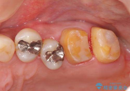 歯周病 側方力に対抗するブリッジ補綴の治療前