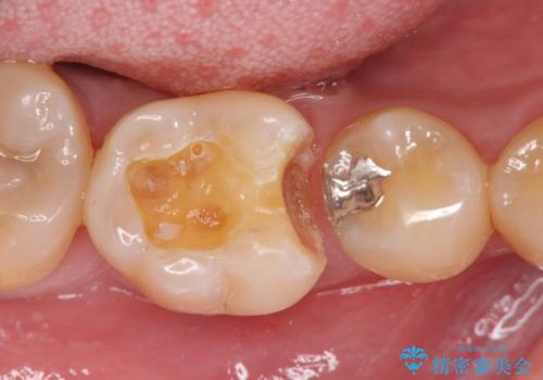 歯の神経を残す、丁寧な虫歯の除去の治療中