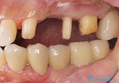 歯周病　側方力に対抗するブリッジ補綴の治療中