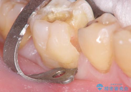 歯の神経を残す、丁寧な虫歯の除去の治療中