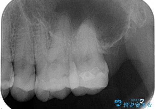 虫歯の治療(セラミックインレー)の治療前