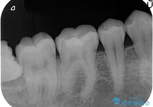 メタルフリーの治療 セラミックインレー の治療後