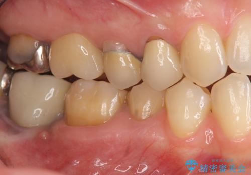 精度の高いセラミッククラウンの治療前
