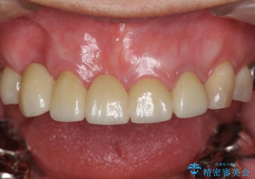 過度な咬合力 歯ぎしりで抜けた歯の欠損補綴の治療後