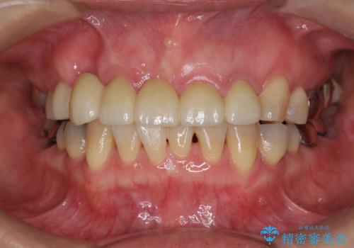 過度な咬合力 歯ぎしりで抜けた歯の欠損補綴の症例 治療後