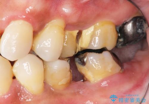 歯周病 側方力に対抗するブリッジ補綴の症例 治療前