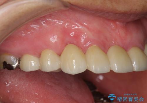 過度な咬合力 歯ぎしりで抜けた歯の欠損補綴の治療後
