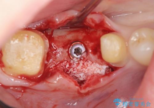 臼歯インプラント補綴の治療中