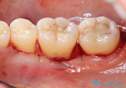 歯周病 再生治療で歯を残すの治療後