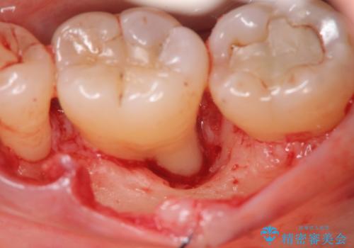 歯周病 再生治療で歯を残すの治療前
