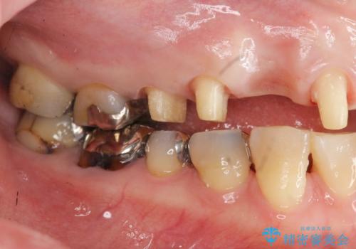 過度な咬合力 歯ぎしりで抜けた歯の欠損補綴の治療中