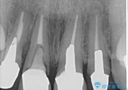 オールセラミッククラウン 折れてしまった前歯の治療の治療前
