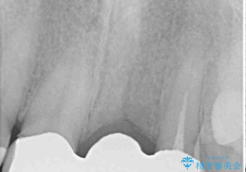 不自然な前歯のブリッジをオールセラミックできれいにの治療前