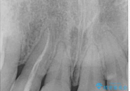 変色した前歯 オーダーメイドタイプのオールセラミッククラウンの治療前