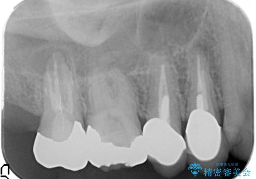 精度の高いセラミッククラウンの治療前