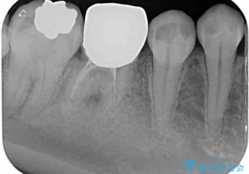 折れてしまった奥歯 下の奥歯のインプラント治療の治療前
