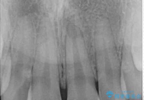 気になる前歯を治したい インビザライン矯正とオールセラミッククラウンの治療前