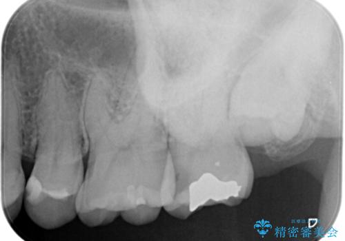 虫歯をセラミックで治療の治療前