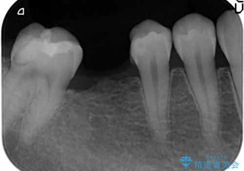 臼歯インプラント補綴の治療前