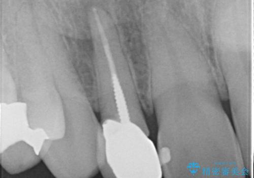 オールセラミッククラウン メタルフリーのクラウンへの治療前