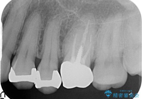 オールセラミッククラウン セラミックインレー 銀歯を白い歯への治療前