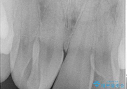 セラミック矯正 気になる前歯の歯並びの改善の治療前