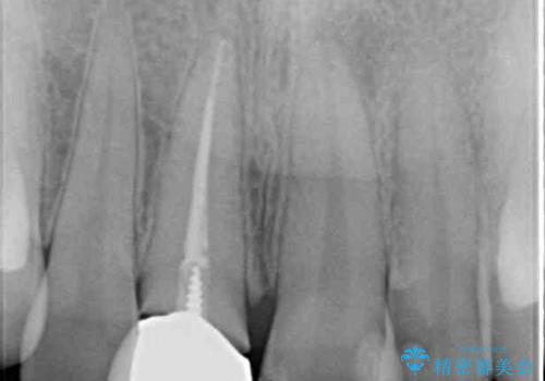 変色した前歯のオールセラミック治療の治療前