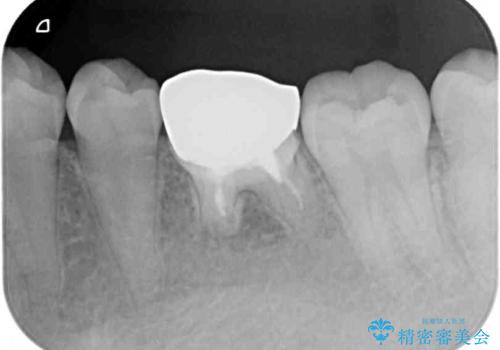 前歯のデコボコを治したい ワイヤー矯正の治療中