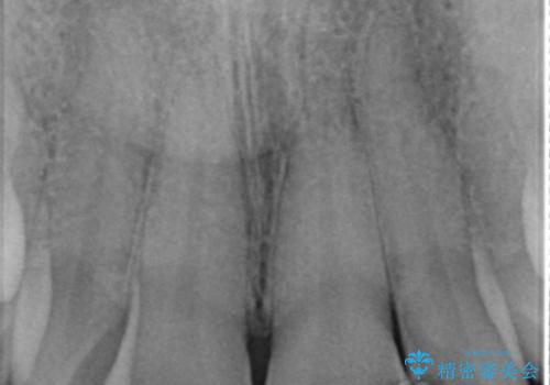 前歯のつめもの きれいにしたい 30代男性の治療前