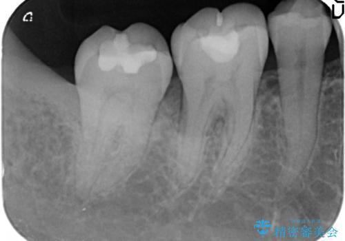 歯周病　再生治療で歯を残すの治療前