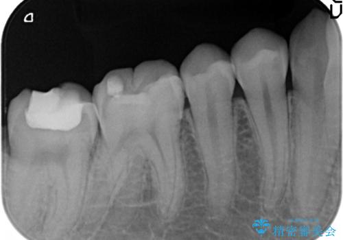 セラミックインレー　銀歯を白い歯への治療後